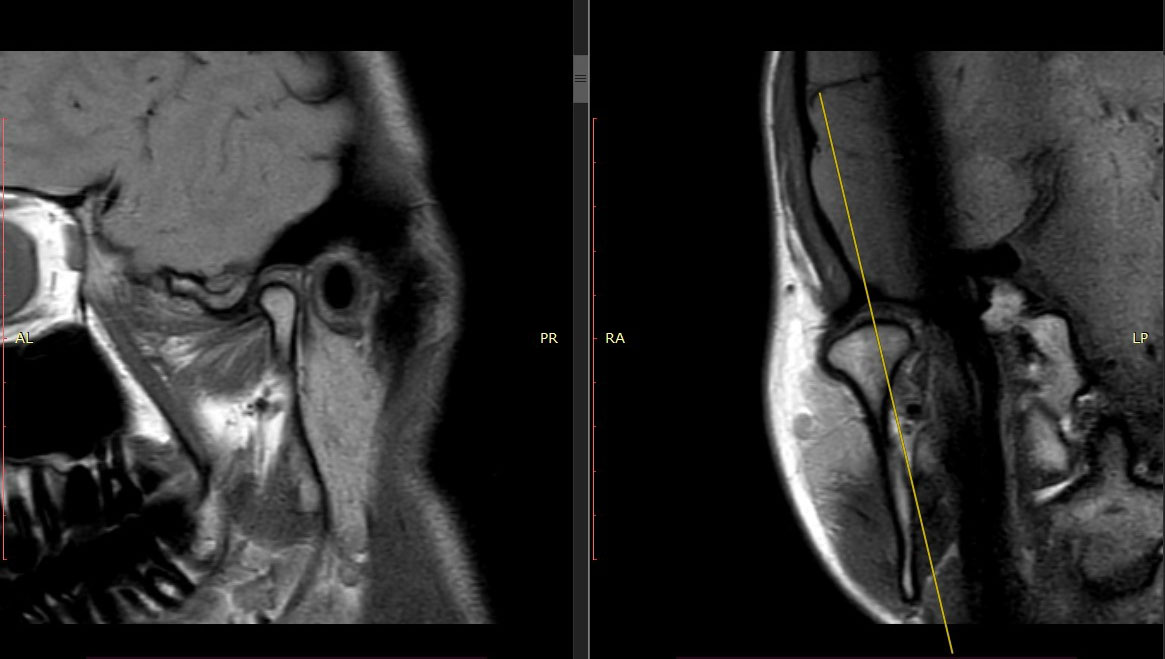 МРТ височно-нижнечелюстного сустава (ВНЧС) - Фото