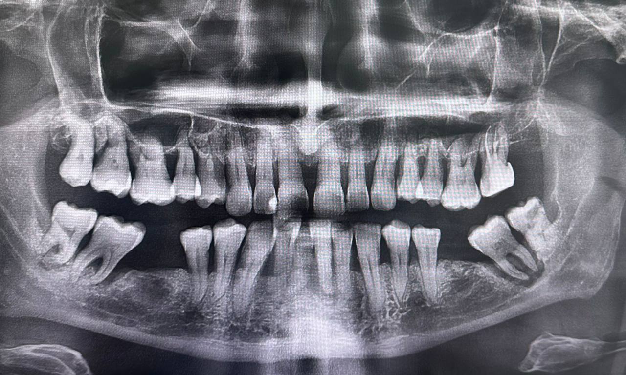 Панорамный снимок  зубов (ОПТГ) - Фото