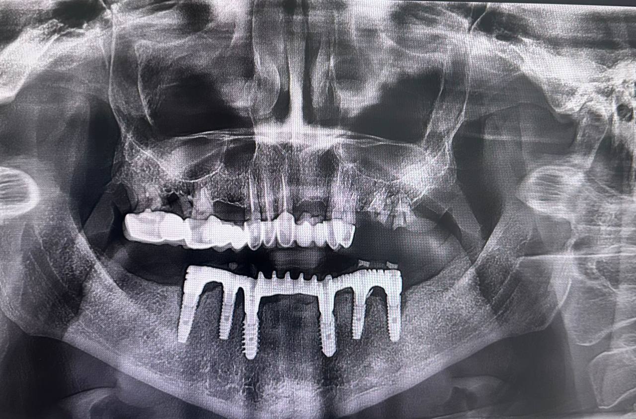 Панорамный снимок  зубов (ОПТГ) - Фото